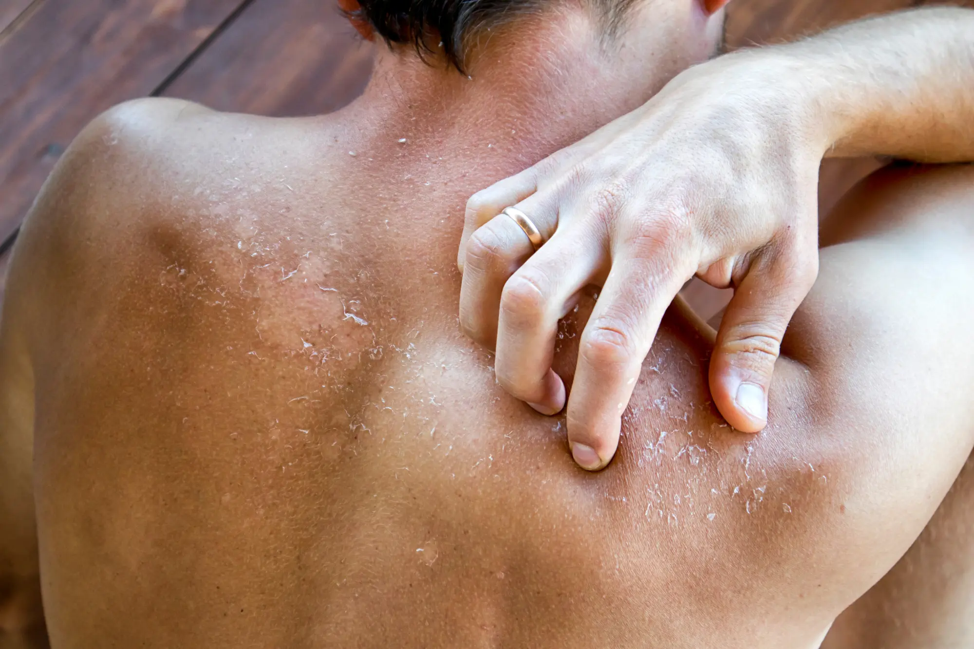An example of dry skin
